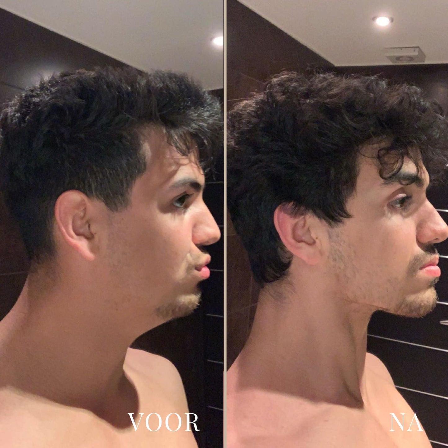 LineLift Jaw Trainer - By Laurain