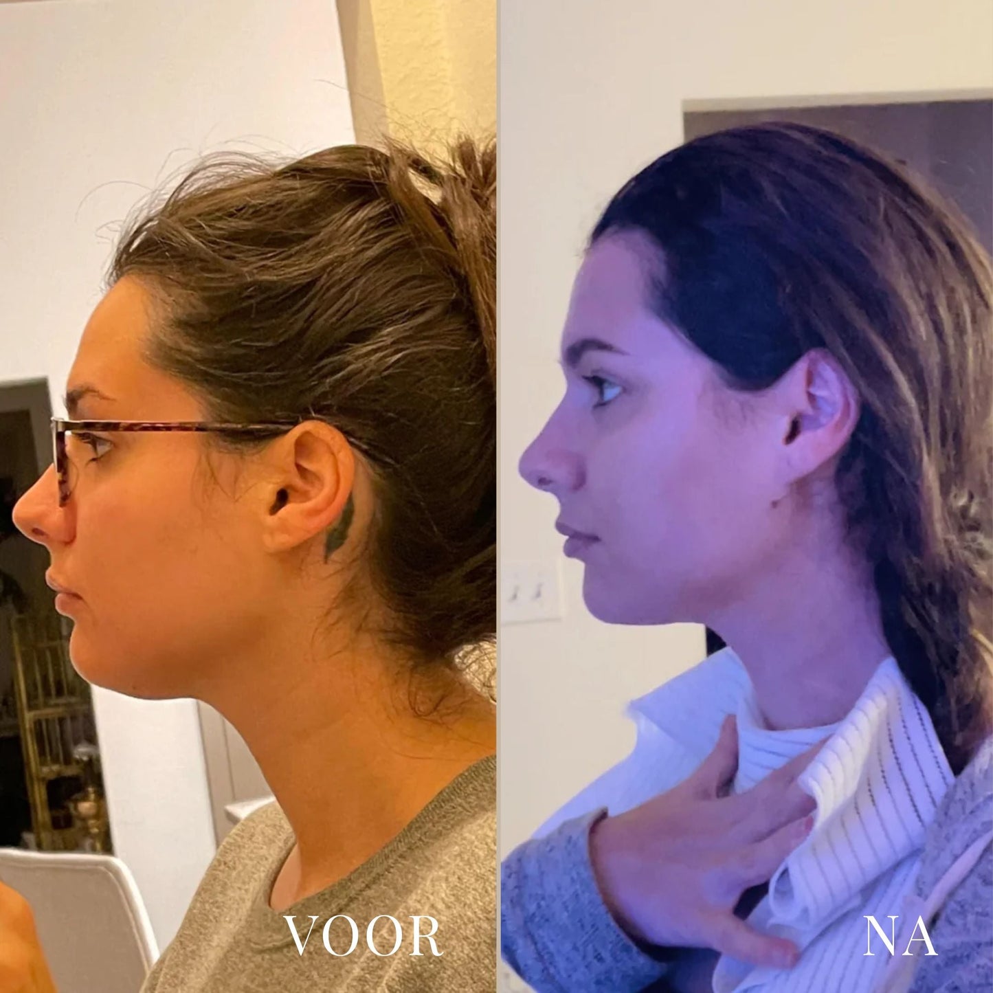 LineLift Jaw Trainer - By Laurain