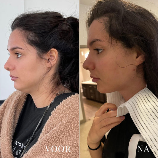 LineLift Jaw Trainer - By Laurain