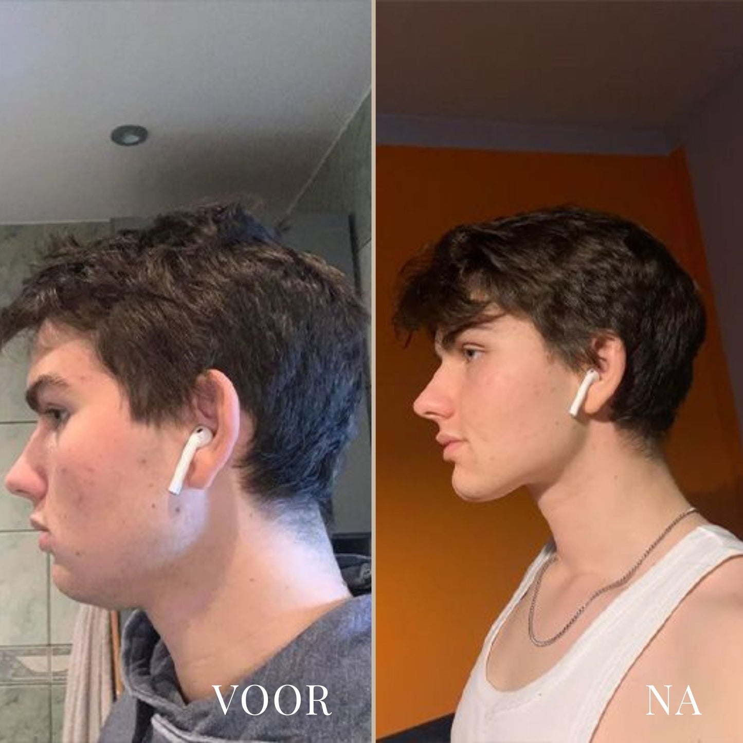 LineLift Jaw Trainer - By Laurain