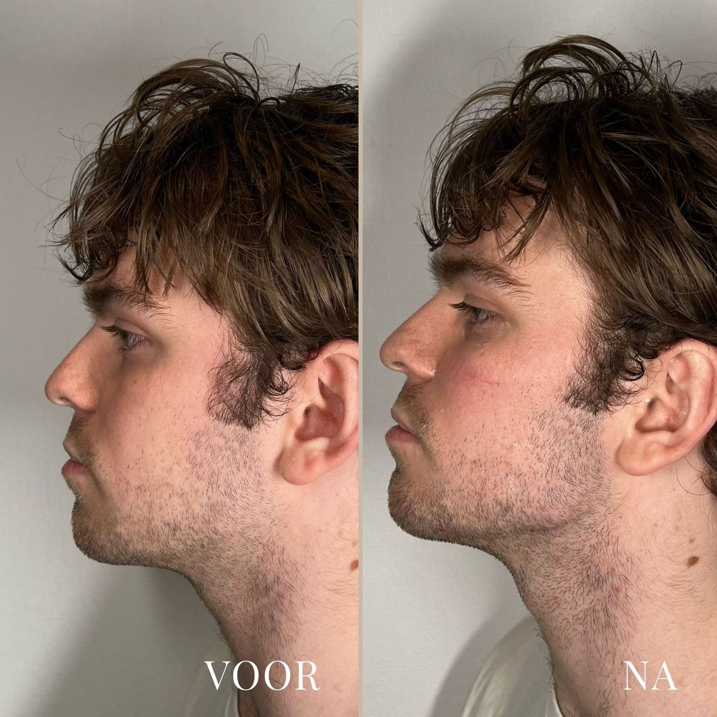 LineLift Jaw Trainer - By Laurain